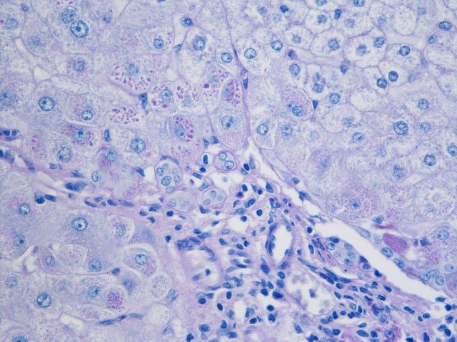 Learning About Alpha-1 Antitrypsin Deficiency - 1